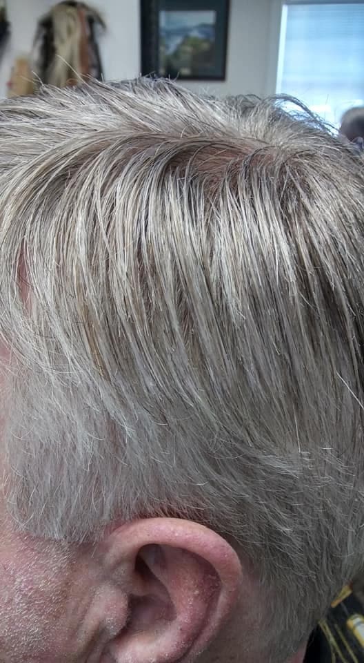 Avanta's Hair Restoration Clinic - hair transplant in Alpharetta, GA