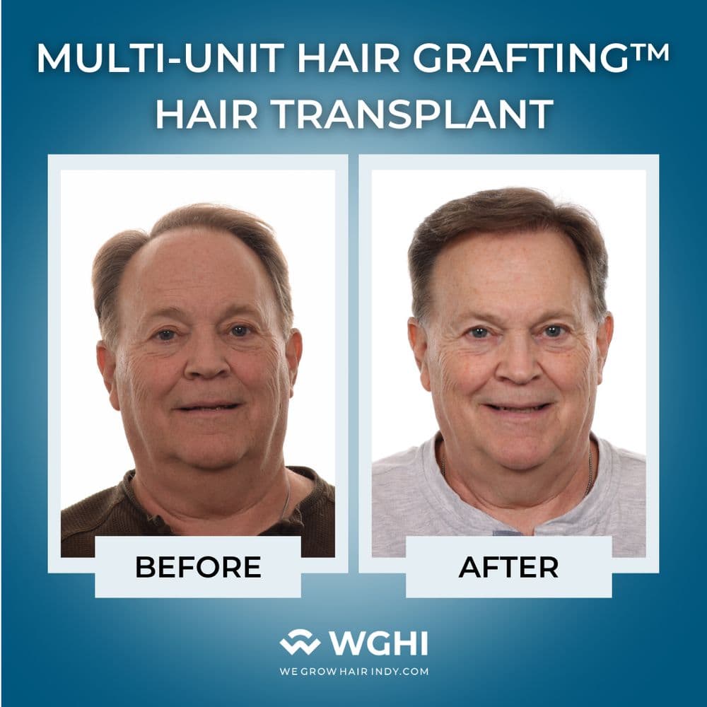We Grow Hair Indy - hair transplant in Indianapolis, IN