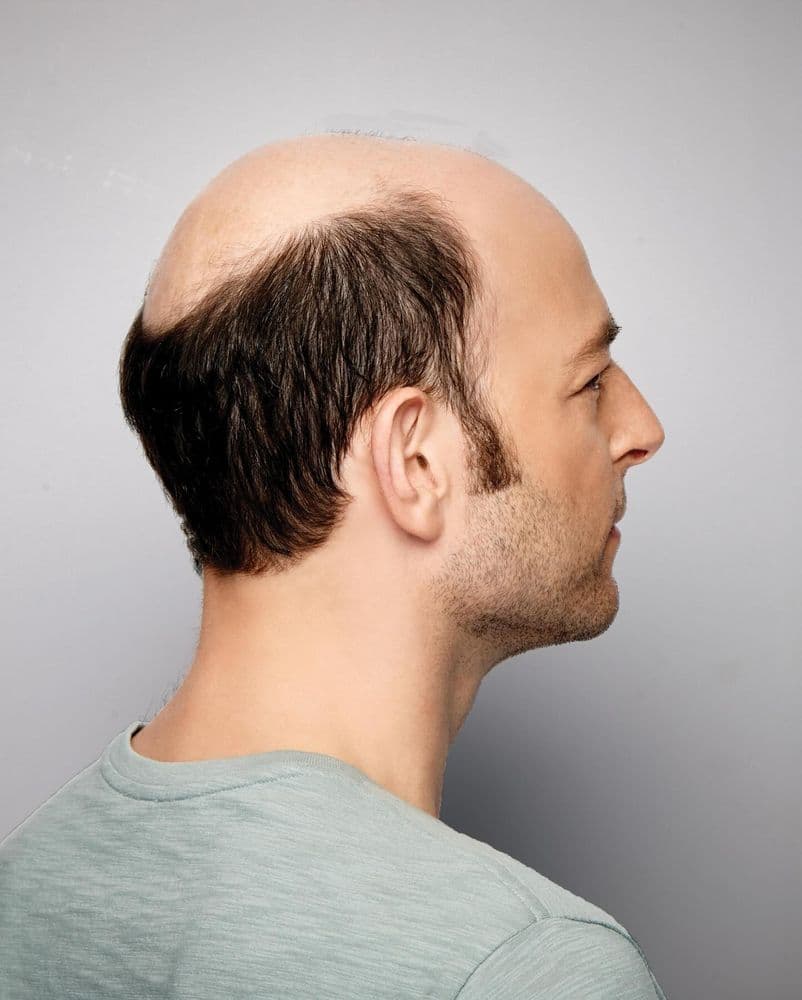 TM Hair - hair transplant in Houston, TX