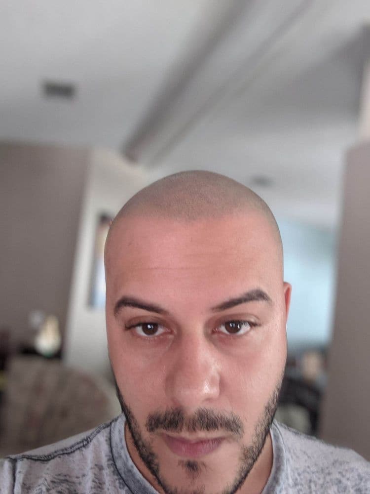 Hairline Studios - hair transplant in Orlando, FL