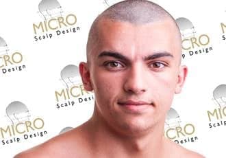 Micro Scalp Design - hair transplant in Sunrise, FL