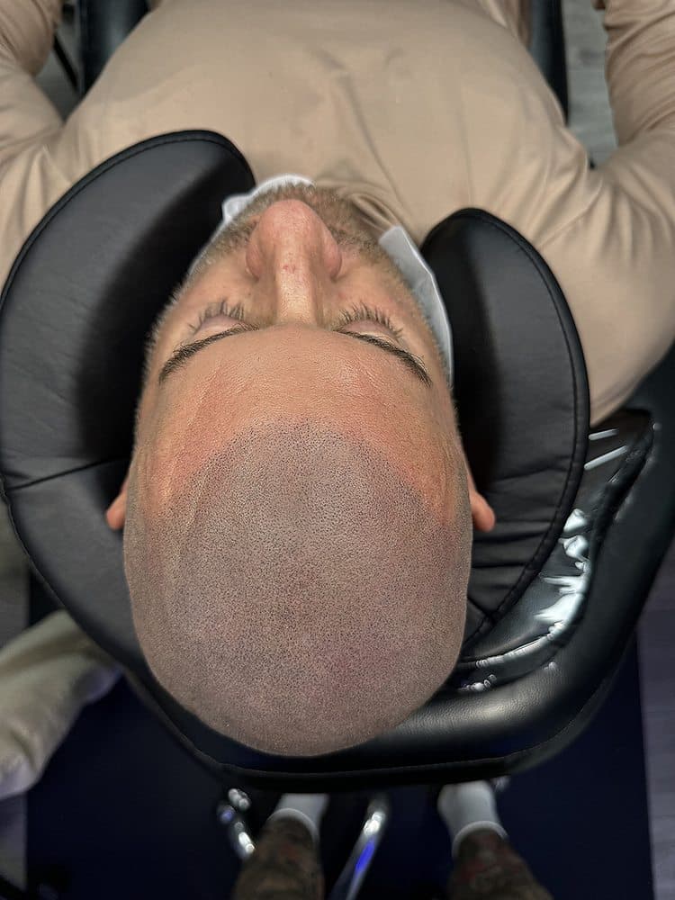 SMP INK - hair transplant in Las Vegas, NV