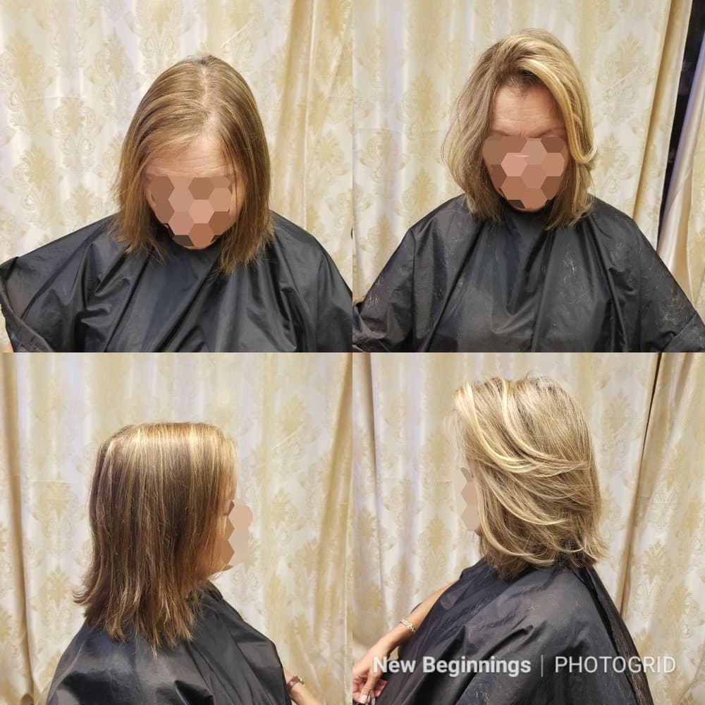 New Beginnings - hair transplant in Marlborough, MA