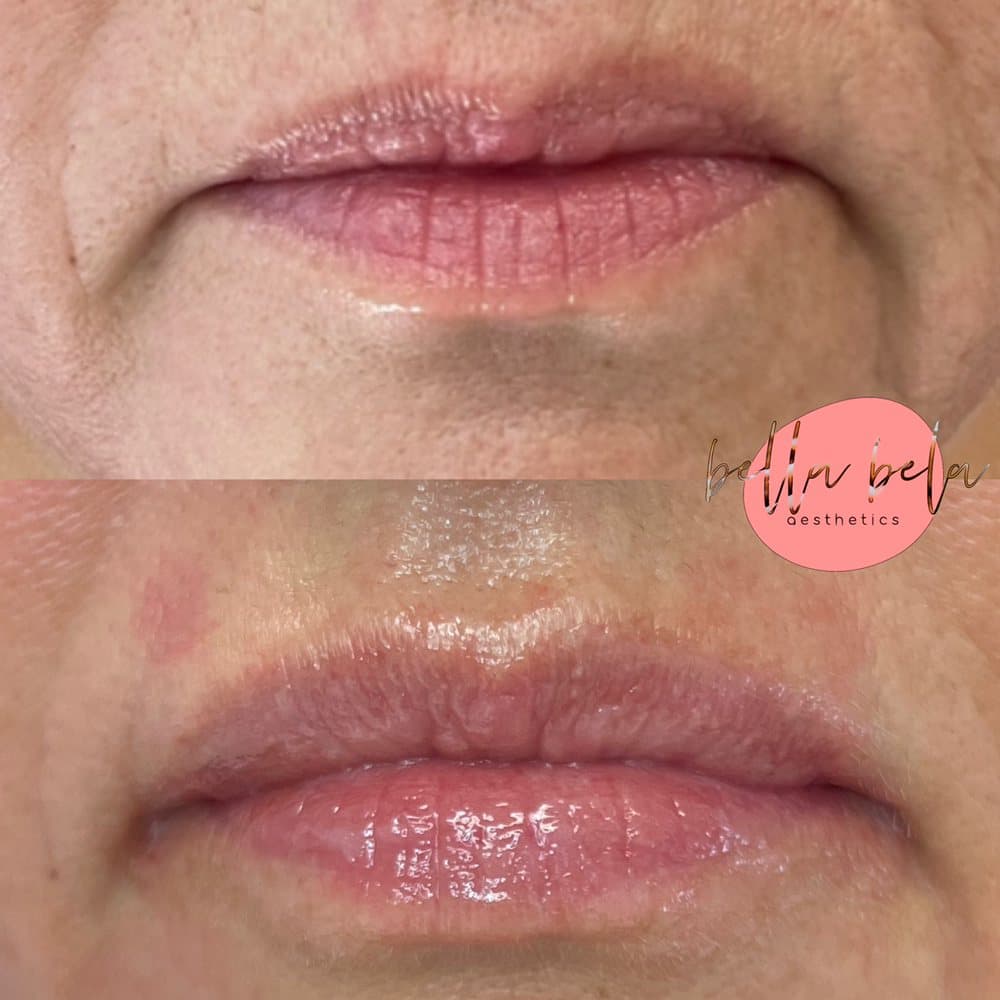 Bella Bela Aesthetics - hair transplant in sherborn, MA