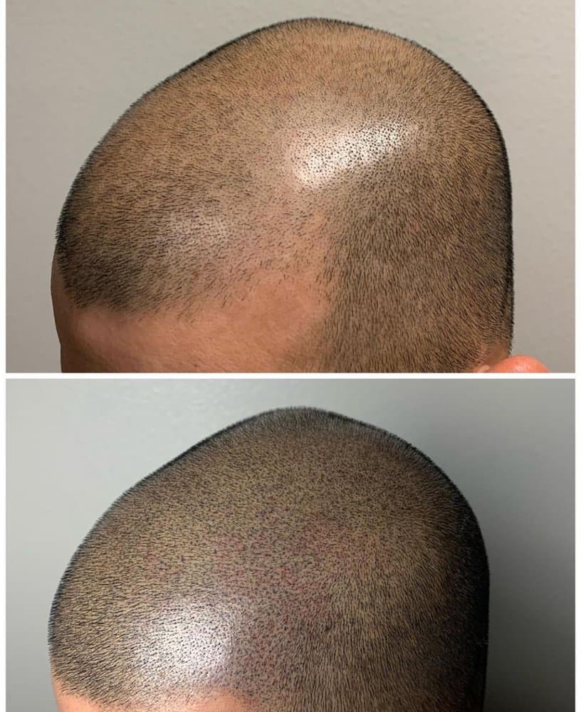 LV Scalp King - hair transplant in Las Vegas, NV