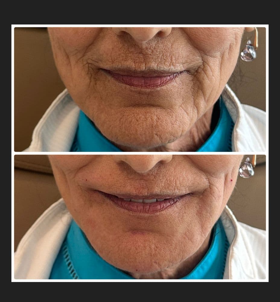 Glow Wilco - hair transplant in Mt. Juliet, TN