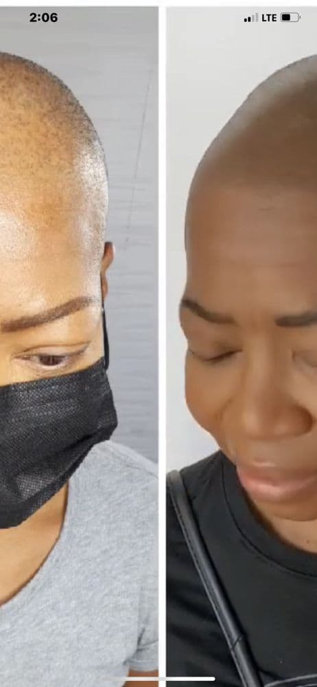 Royal Scalp Micro - hair transplant in Albuquerque , NM