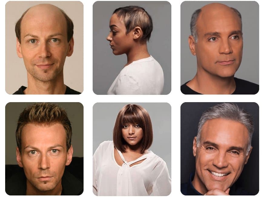 Studio 4:13 Hair Replacement - hair transplant in Addison, TX