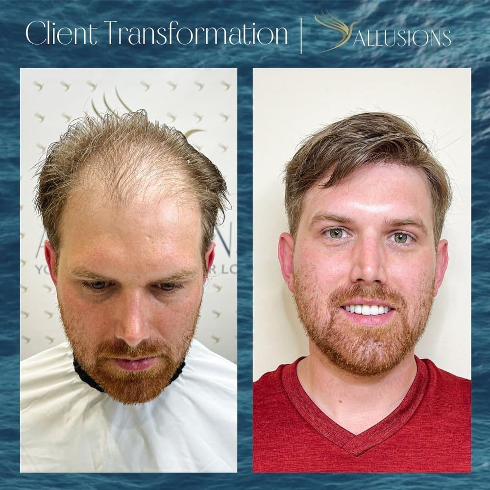 Allusions Hair Replacement Studio - hair transplant in Cincinnati, OH