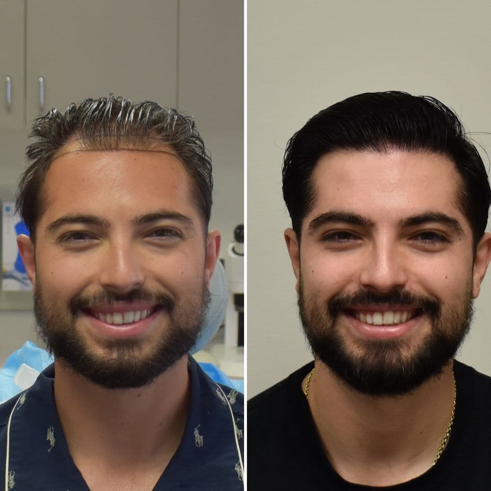 Los Angeles FUE Hair Transplant Clinic - hair transplant in Pasadena, CA