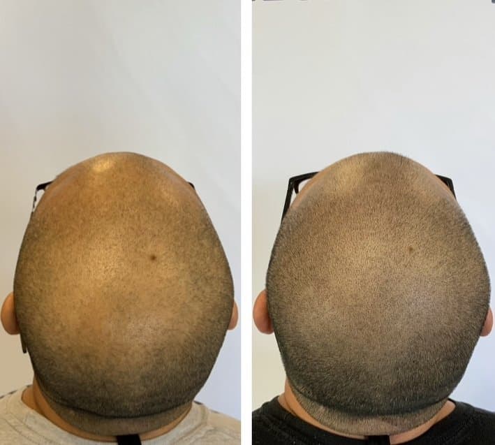 Replicate SMP - hair transplant in West Linn, OR