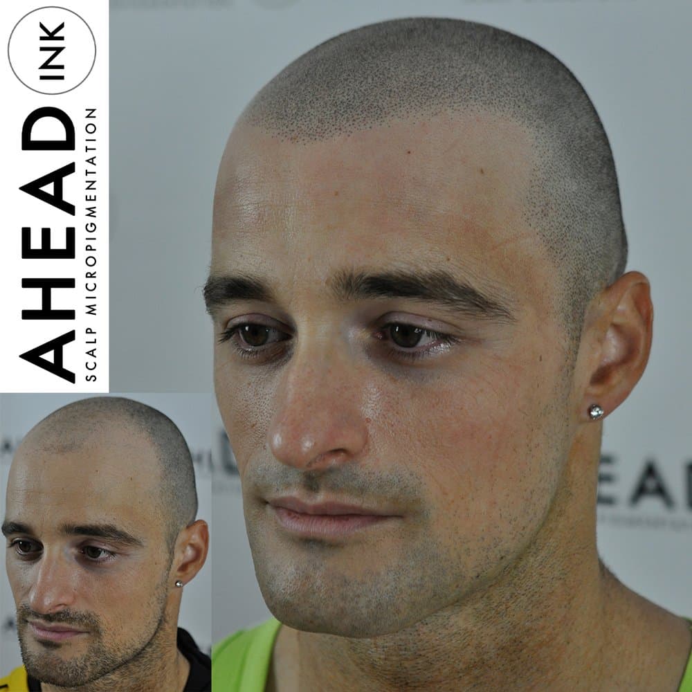 Ahead Ink - hair transplant in North Bergen, NJ