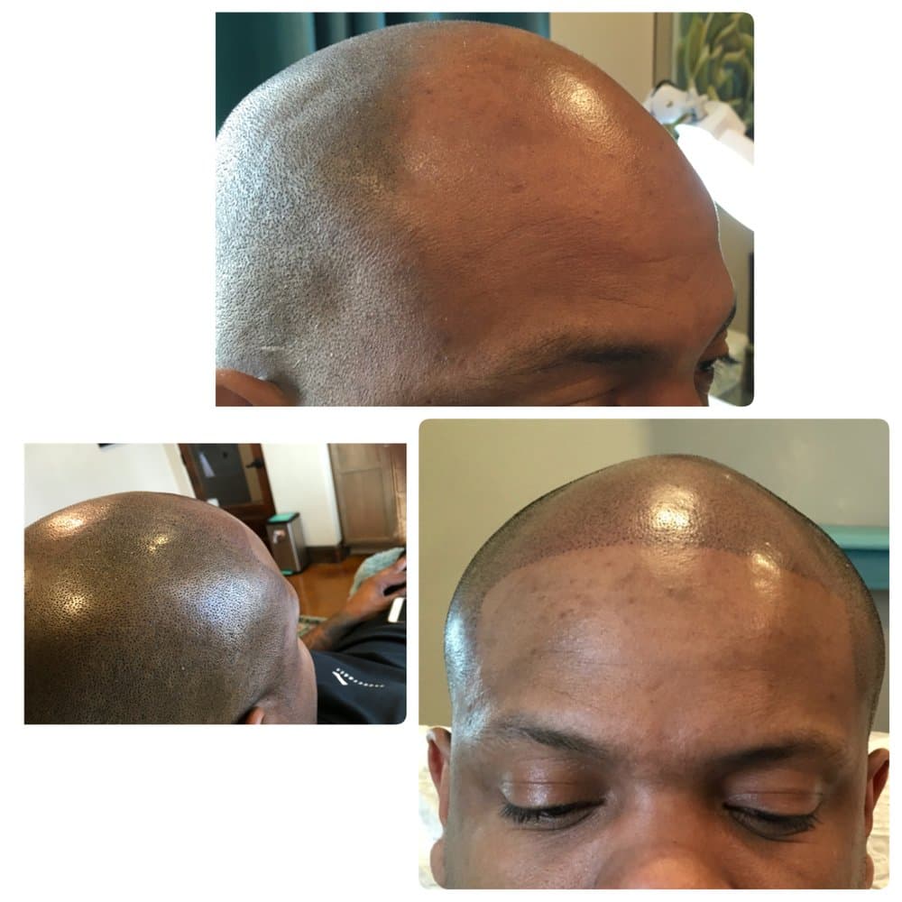 Micropigmentation - Scalp Shoppe - hair transplant in Lewisville, TX