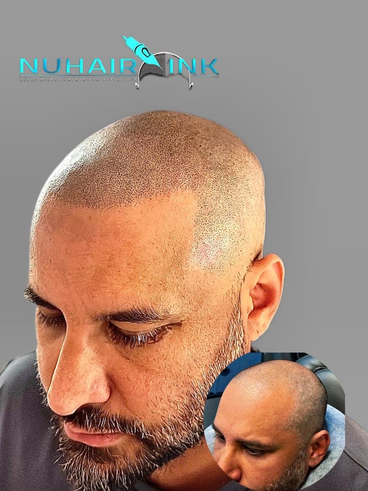 NuHair Ink - hair transplant in Roseville, CA