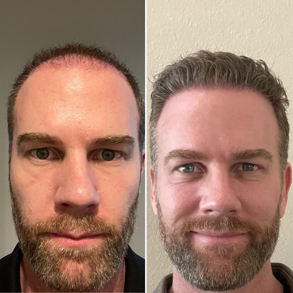 LA FUE Hair - New York - hair transplant in Garden City, NY