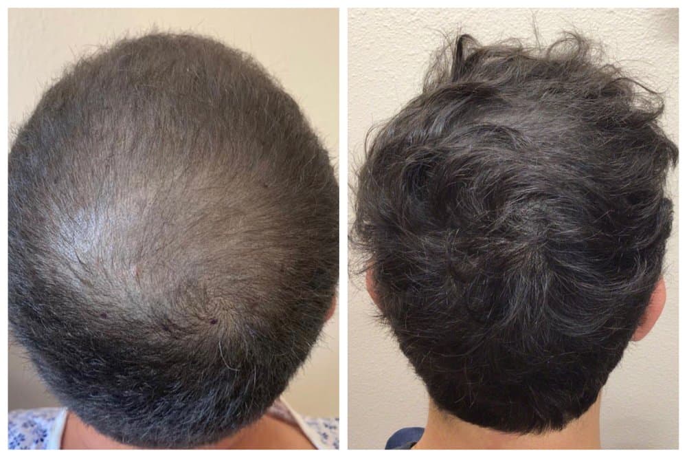 La Mesa Medical Hair Restoration - hair transplant in La Mesa, CA