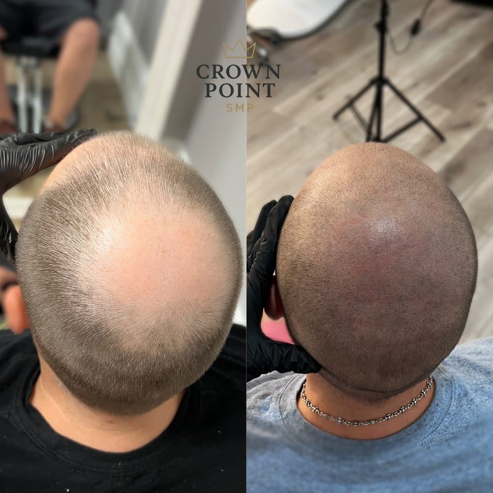 Crown Point SMP - hair transplant in Roseville, CA