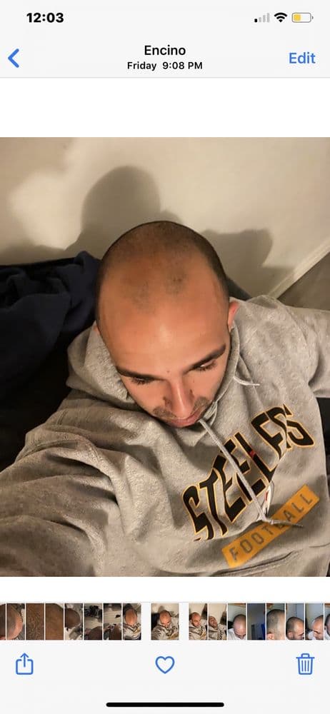 Deja Vu Hair Design - hair transplant in Woodland Hills, CA