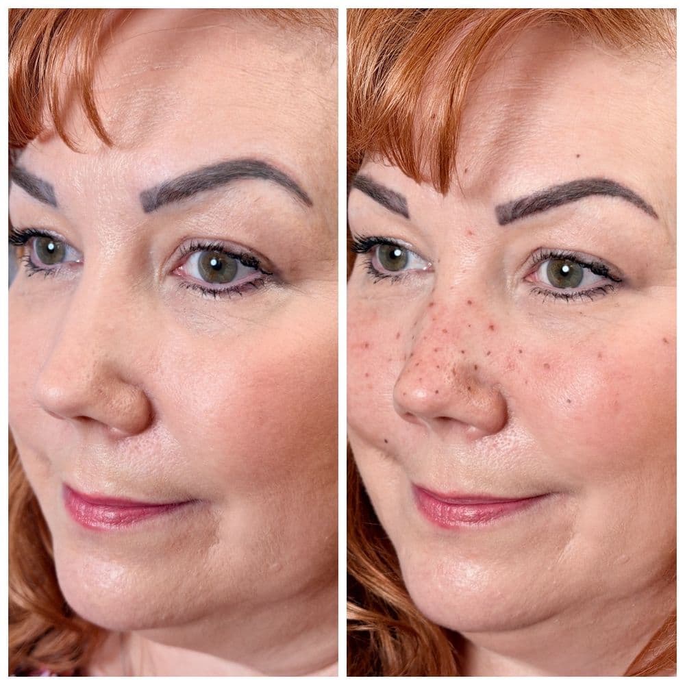 Monarch - hair transplant in Eugene, OR