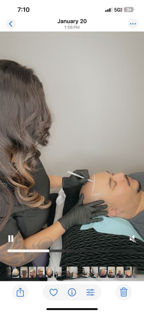 Renew U SMP - hair transplant in Roseville, CA