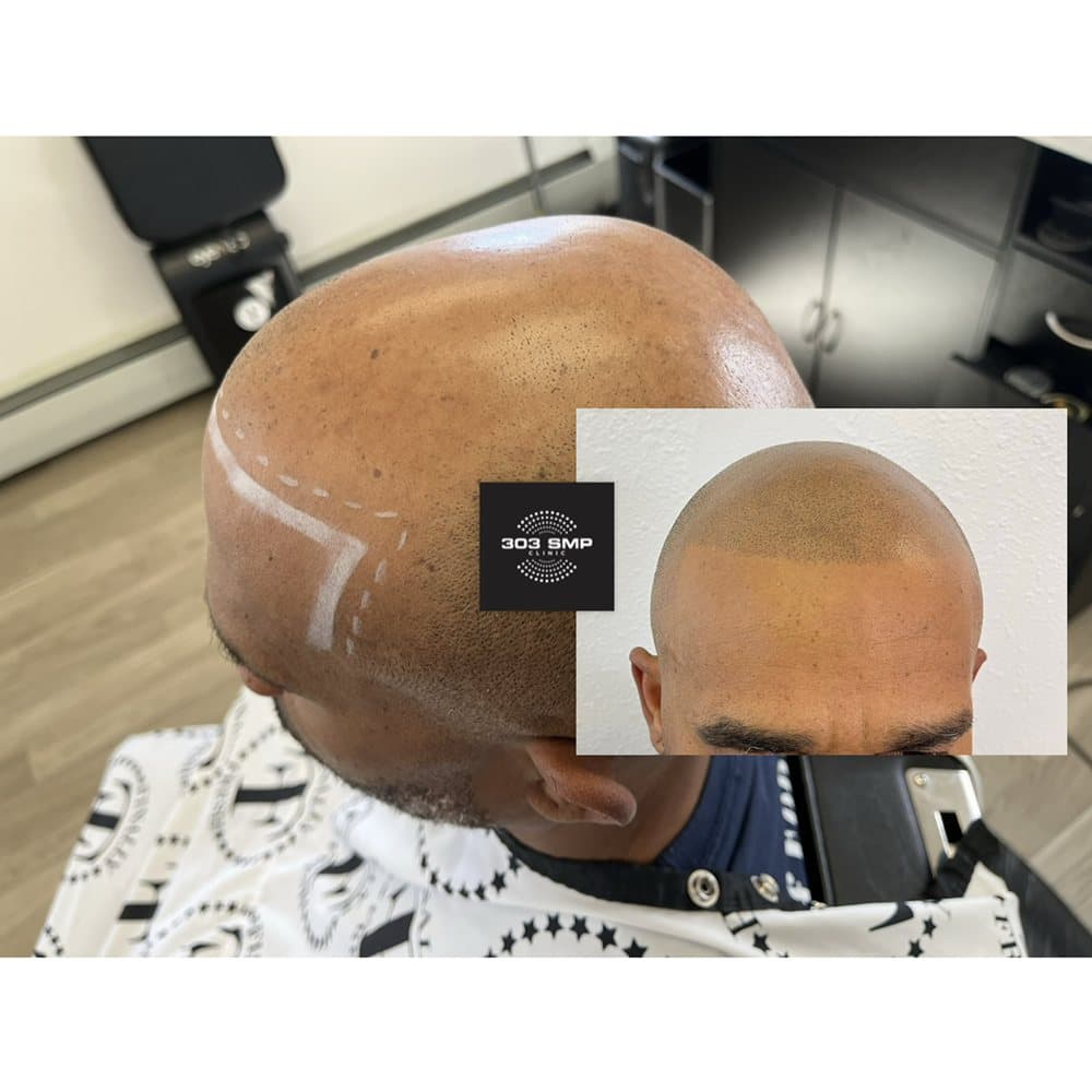 303 SMP Clinic - hair transplant in Broomfield, CO