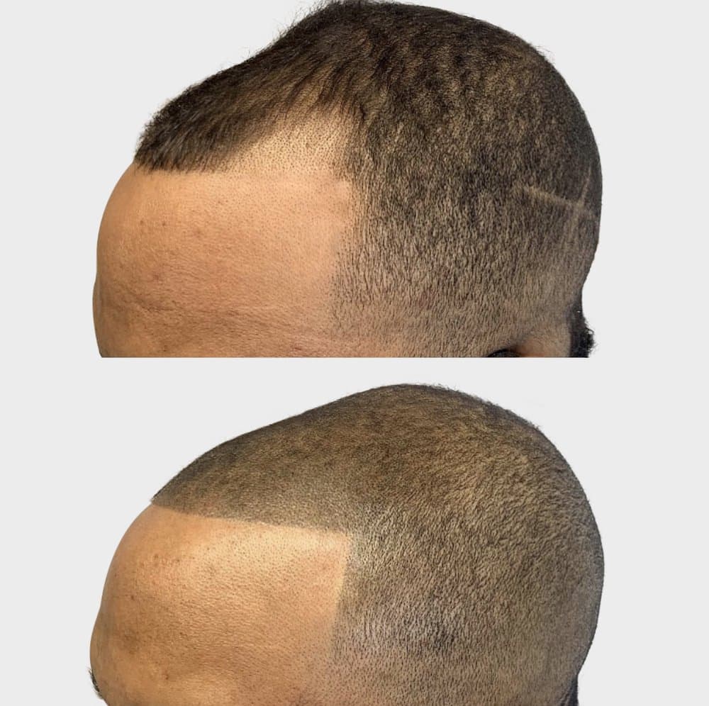 Density Ink - hair transplant in Las Vegas, NV
