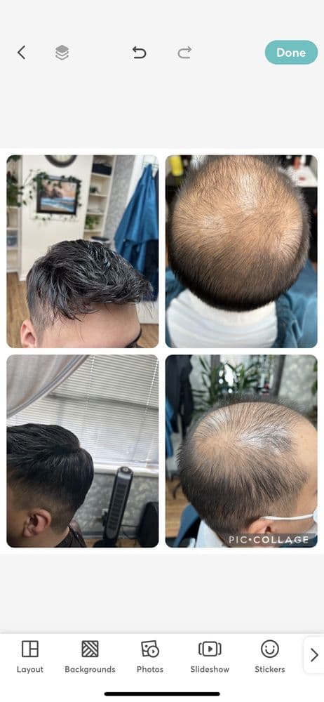 I Look Good - hair transplant in San Jose, CA