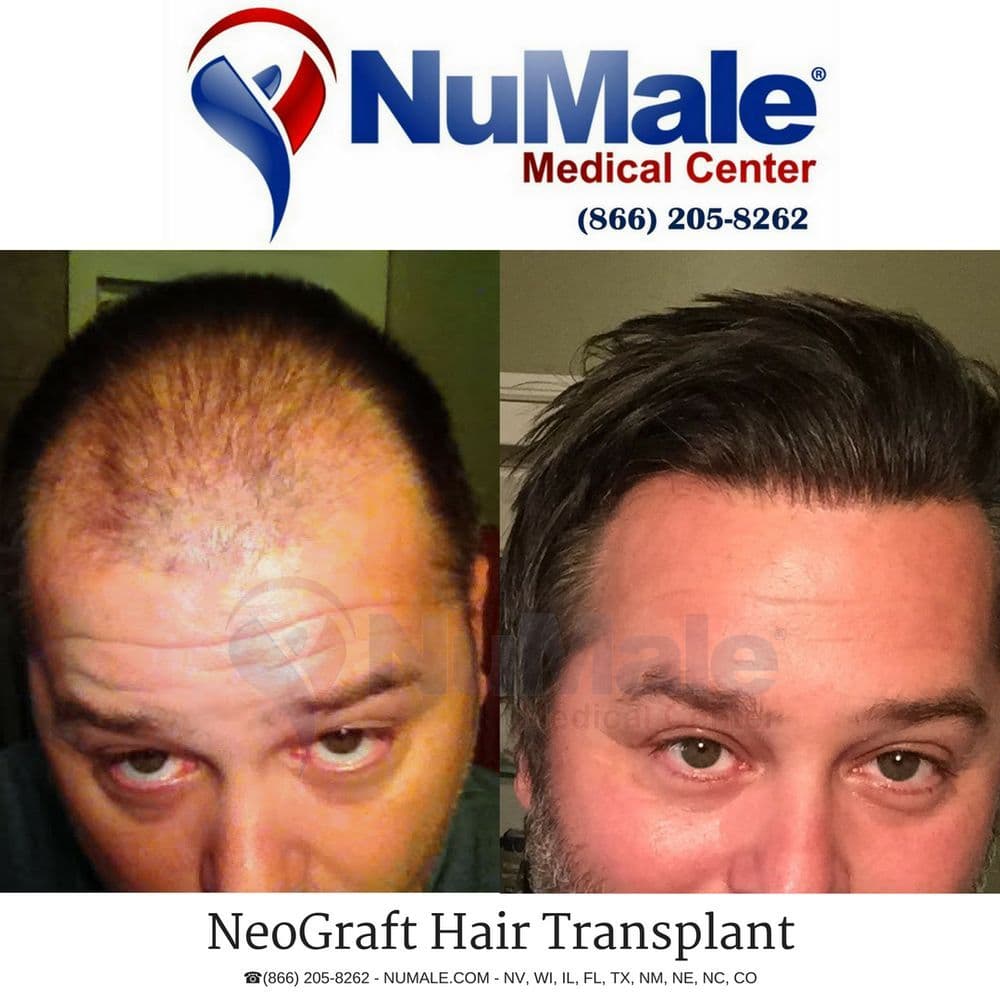NuMale Medical Center - hair transplant in Omaha, NE