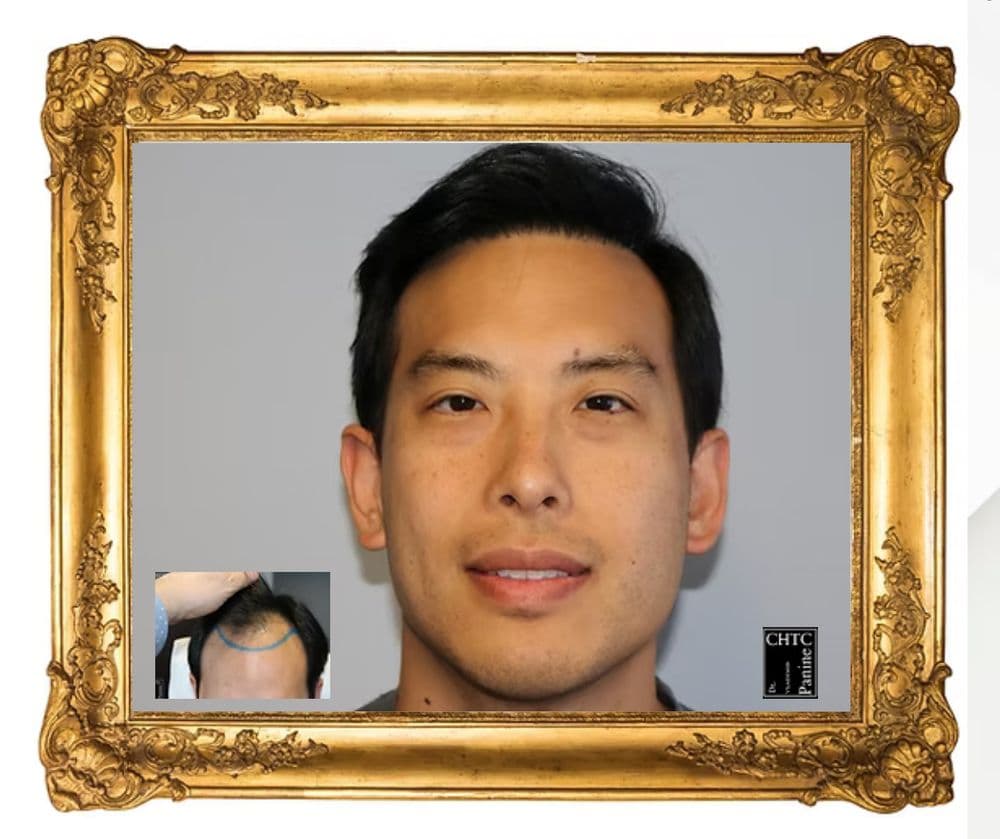 PANINE, MD - Chicago Hair Transplant Clinic - hair transplant in Chicago, IL