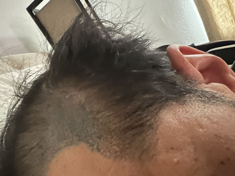 MM Scalp Aesthetics - hair transplant in Henderson, NV