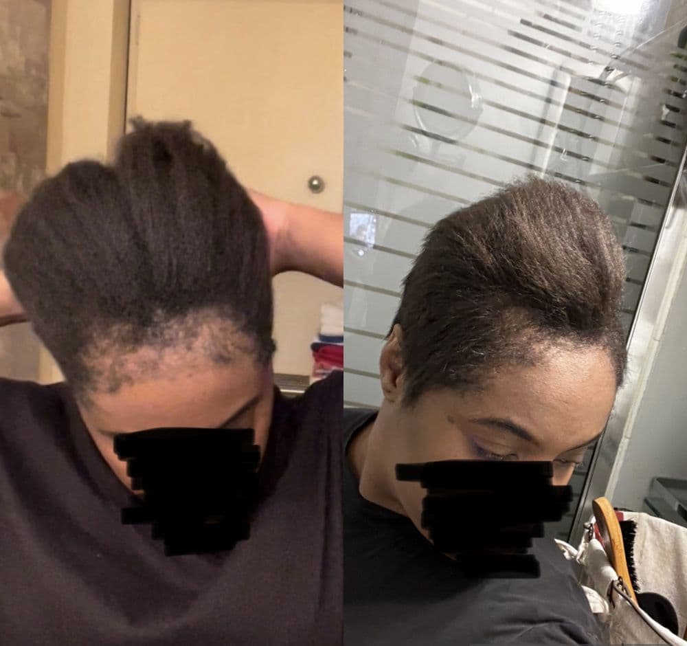 Foundation for Hair Restoration - hair transplant in Miami, FL