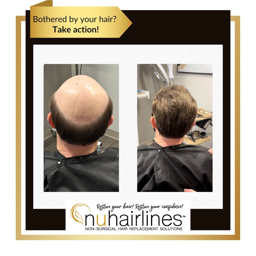 Nuhairlines - hair transplant in Scottsdale, AZ