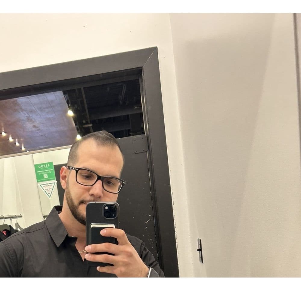 Robotic Hair RX - hair transplant in Tempe, AZ