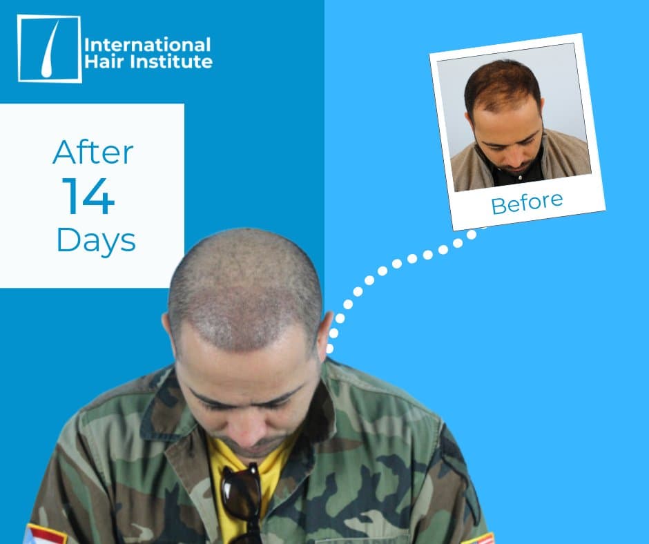 International Hair Institute - Hair Transplant Chicago - hair transplant in Chicago, IL