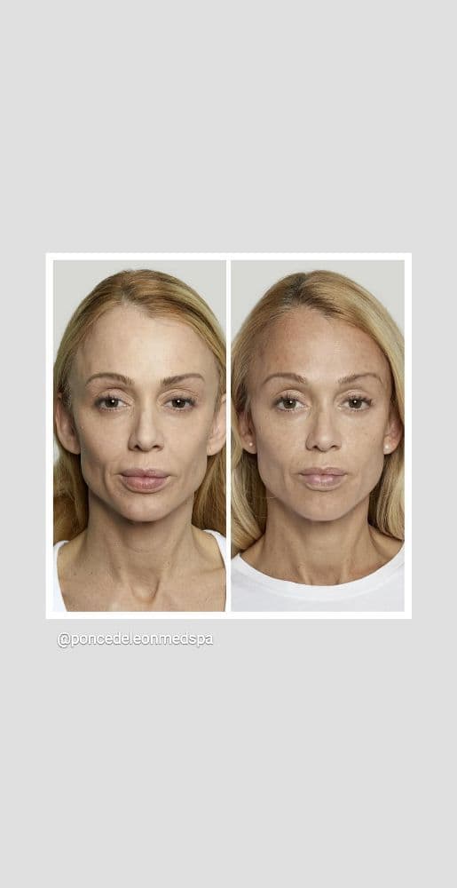 Ponce De Leon Med Spa - hair transplant in Stoneham, MA