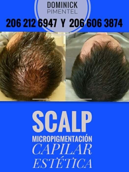 SCALP Clínic Pimentel - hair transplant in Federal Way, WA