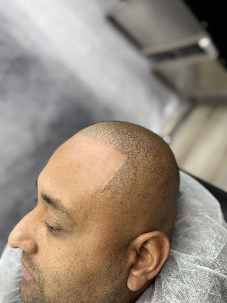 KAL's SMP & Hair Replacement Clinic - hair transplant in Colorado Springs, CO