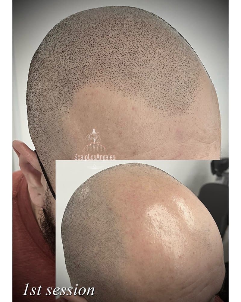 Scalp Los Angeles - hair transplant in Sherman Oaks, CA