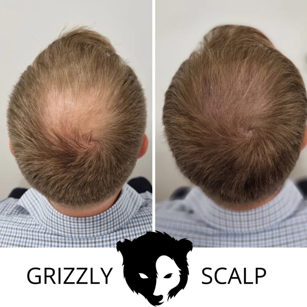 Grizzly Scalp - hair transplant in San Diego, CA