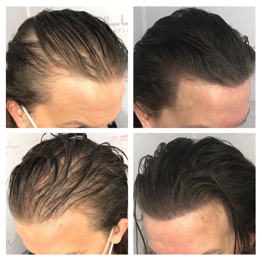 Full Micropigmentation - hair transplant in Las Vegas, NV