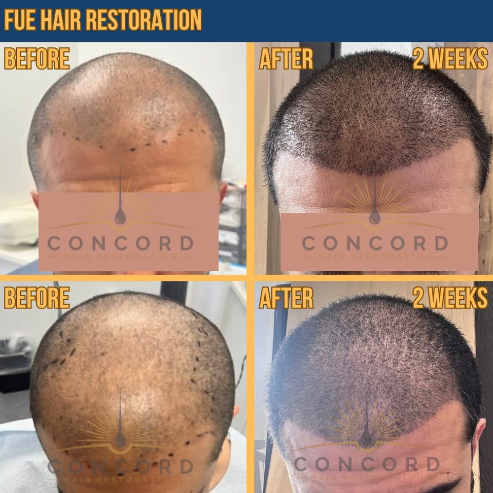 Concord Hair Restoration - hair transplant in Encino, CA