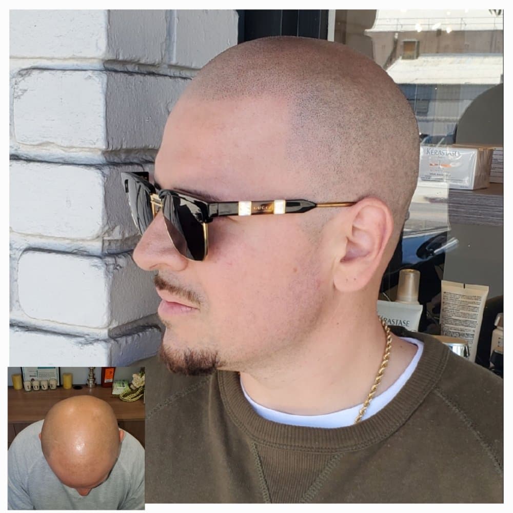 Scalp Micropigmentation by HairDot SMP - hair transplant in Sherman Oaks, CA