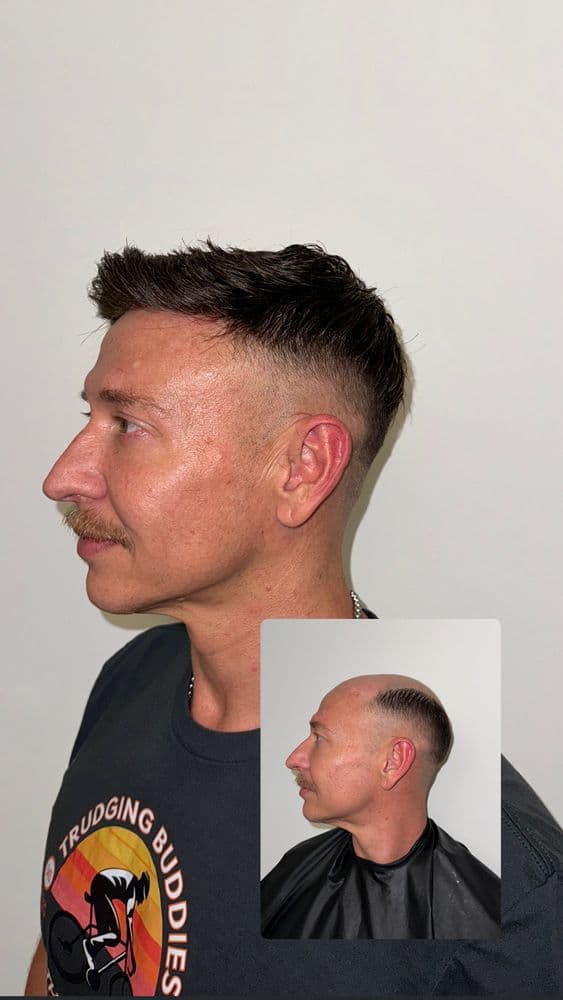 Hairline Revival - hair transplant in Los Angeles, CA