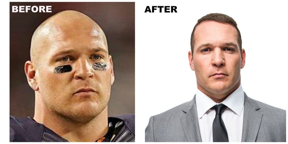 RESTORE - hair transplant in Plano, TX