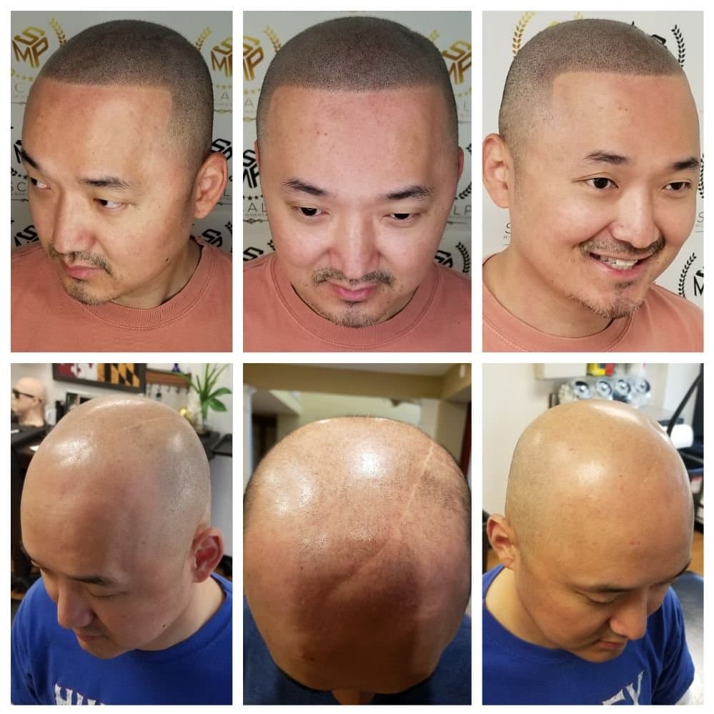 Scalp Micropigmentation - hair transplant in Kensington, MD