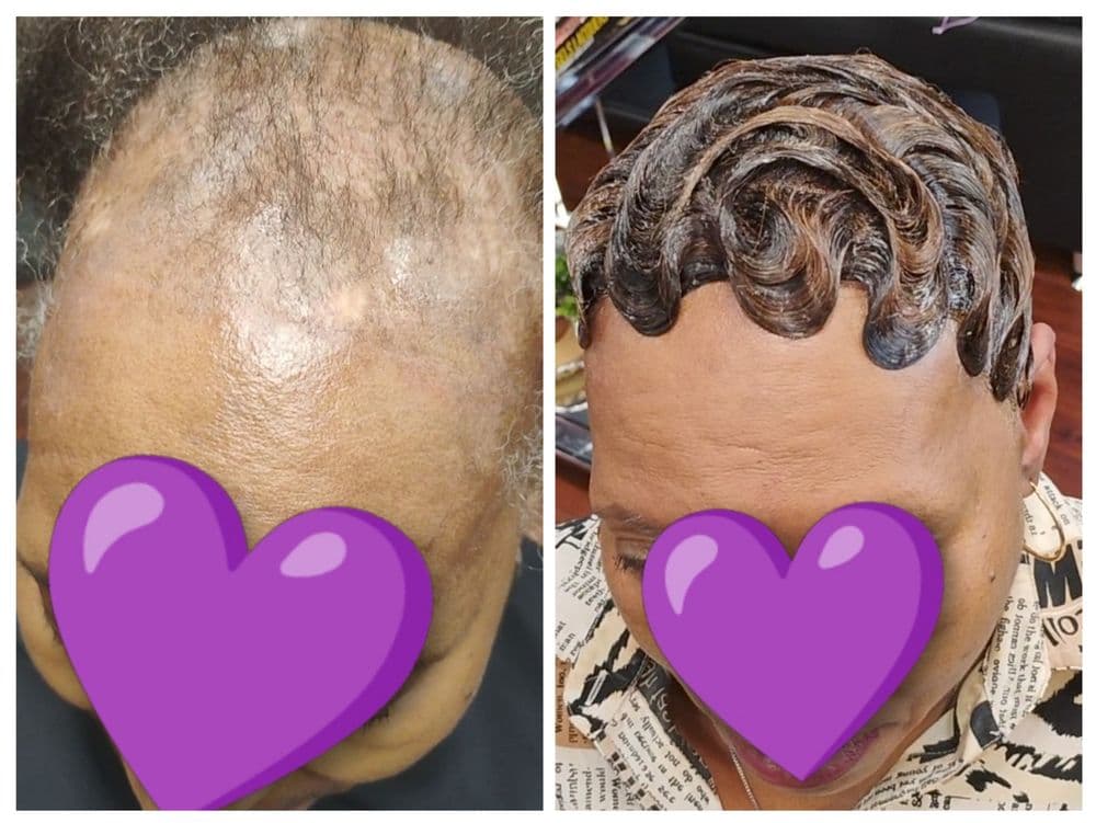 Hairbyleathia - hair transplant in Jacksonville, FL