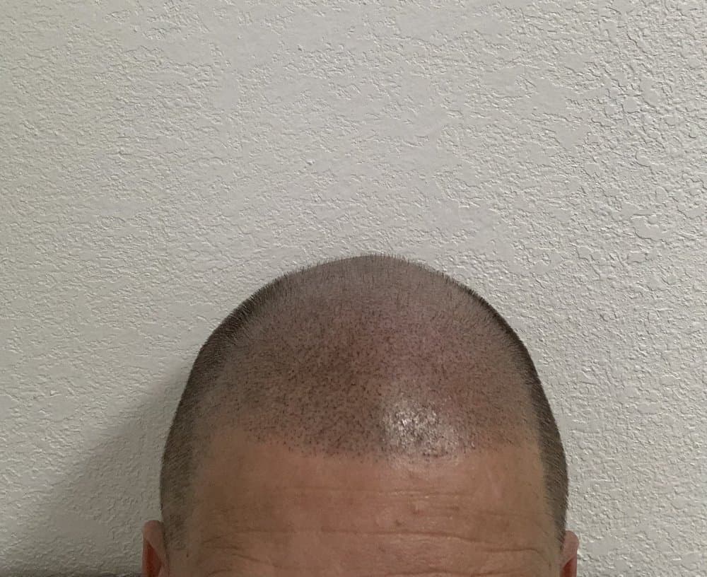 Vello Ink - hair transplant in Miami, FL