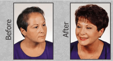 DermaTech - hair transplant in Murray, UT