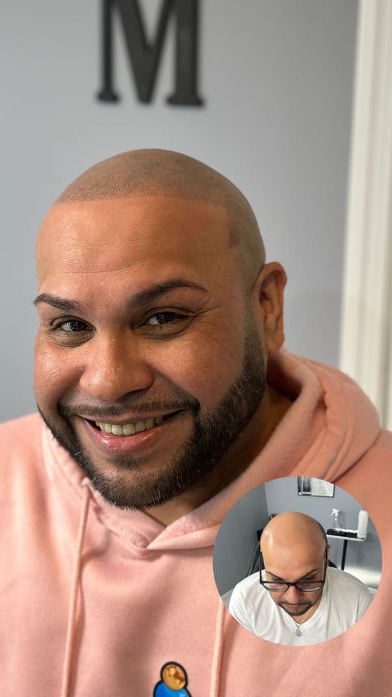 Chasing Impressions - hair transplant in Monroe, NJ