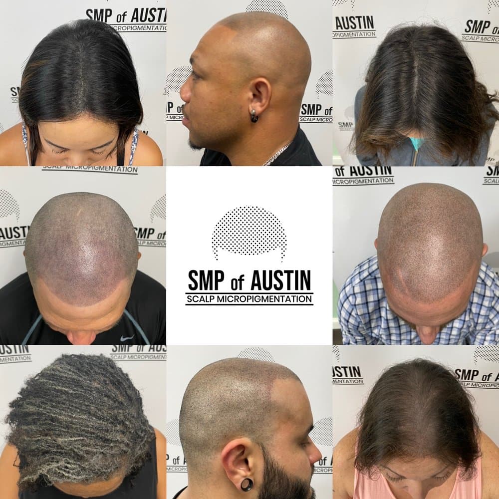 SMP of Austin - hair transplant in Austin, TX